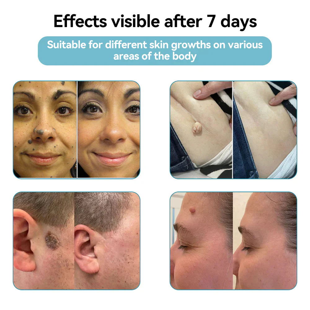 Bikenda® VelvetSkin+ All-in-One Laser Eraser Pen (Powered by CO₂ laser technology – effectively removes moles, warts, skin tags, pigmentation spots, and other skin imperfections)