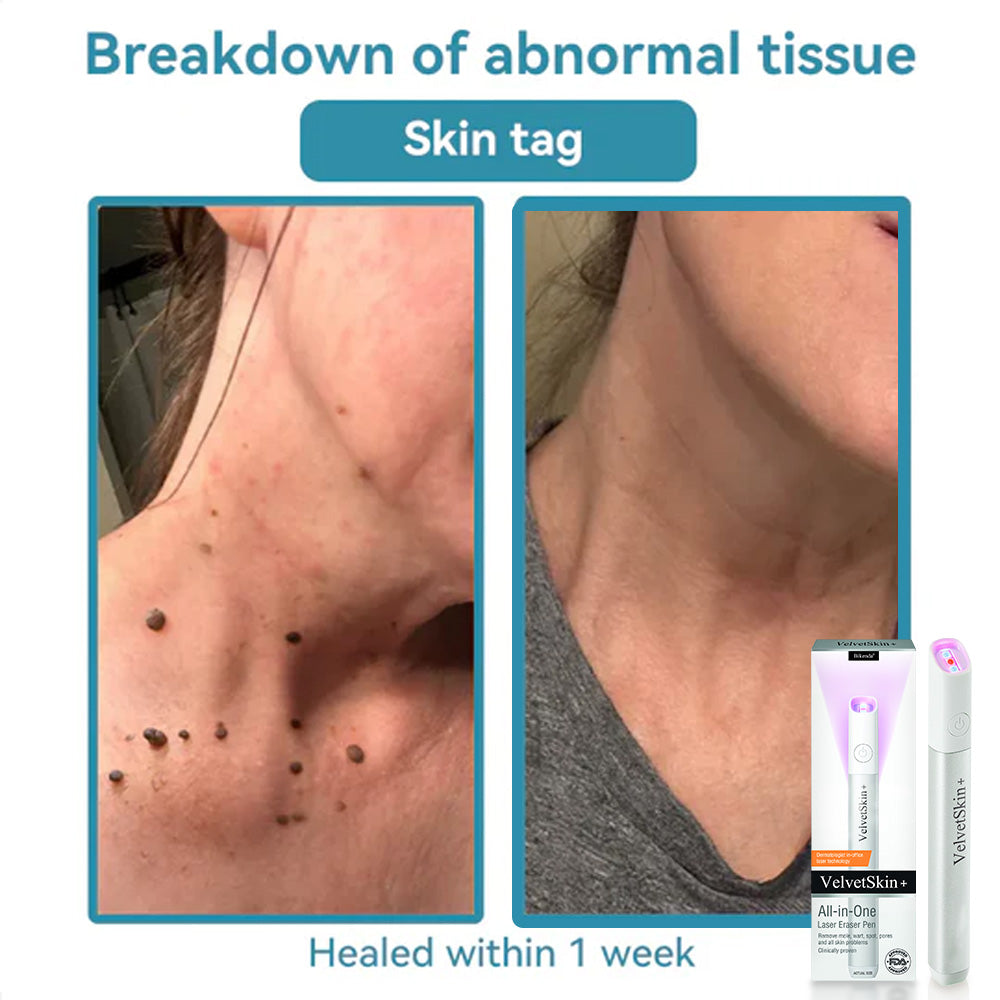 Bikenda® VelvetSkin+ All-in-One Laser Eraser Pen (Powered by CO₂ laser technology – effectively removes moles, warts, skin tags, pigmentation spots, and other skin imperfections)