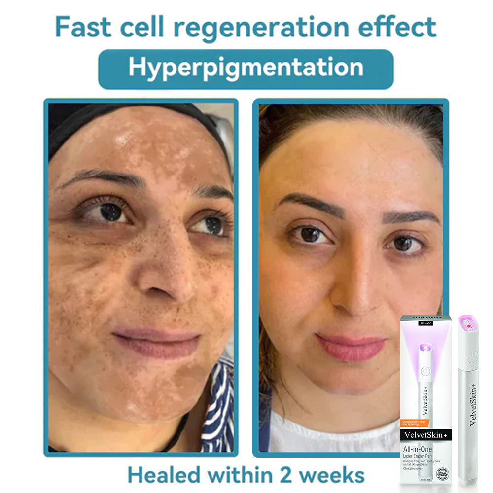 Bikenda® VelvetSkin+ All-in-One Laser Eraser Pen (Powered by CO₂ laser technology – effectively removes moles, warts, skin tags, pigmentation spots, and other skin imperfections)