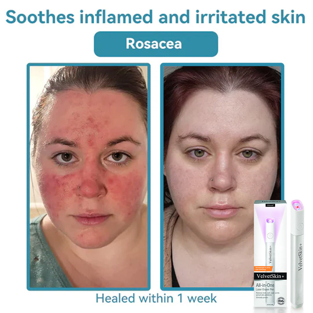Bikenda® VelvetSkin+ All-in-One Laser Eraser Pen (Powered by CO₂ laser technology – effectively removes moles, warts, skin tags, pigmentation spots, and other skin imperfections)