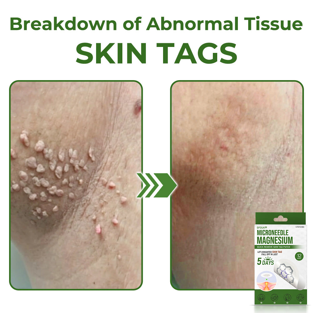 GFOUK® Magnesium MicroNeedle Quick Remove Skin Tag Patches