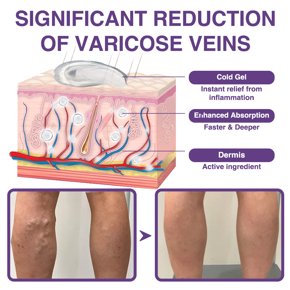 𝐎𝐮𝐫𝐥𝐲𝐚𝐫𝐝® 𝐅𝐞𝐞𝐋𝐞𝐠 𝐂𝐚𝐫𝐞 𝐏𝐡𝐲𝐭𝐨 𝐆𝐞𝐥 - Treat Varicose Veins, Swelling, Cramps, and Leg Pain