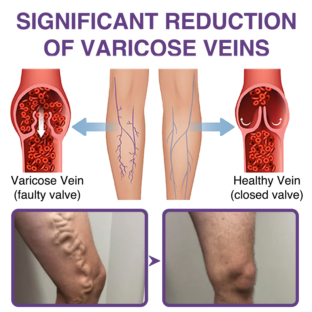𝐎𝐮𝐫𝐥𝐲𝐚𝐫𝐝® 𝐅𝐞𝐞𝐋𝐞𝐠 𝐂𝐚𝐫𝐞 𝐏𝐡𝐲𝐭𝐨 𝐆𝐞𝐥 - Treat Varicose Veins, Swelling, Cramps, and Leg Pain