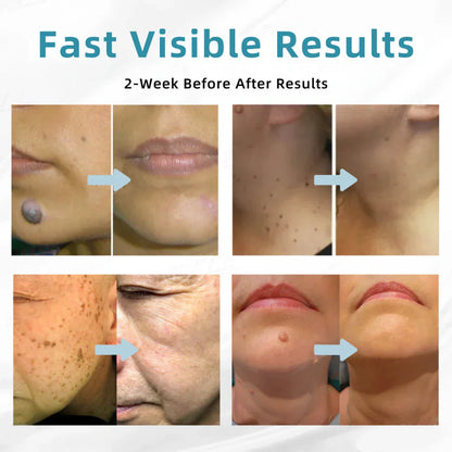 Bikenda® VelvetSkin+ All-in-One Laser Eraser Pen (Powered by CO₂ laser technology – effectively removes moles, warts, skin tags, pigmentation spots, and other skin imperfections)