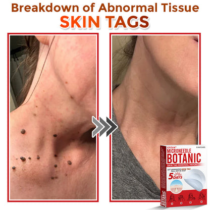 GFOUK® MicroNeedle Botanic Skin Tag Removal Patch 🇺🇸 Made in the USA