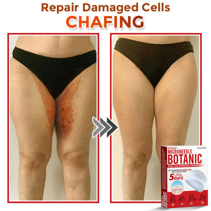 GFOUK® MicroNeedle Botanic Skin Tag Removal Patch 🇺🇸 Made in the USA