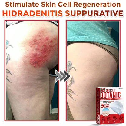 GFOUK® MicroNeedle Botanic Skin Tag Removal Patch 🇺🇸 Made in the USA