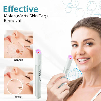Bikenda® VelvetSkin+ All-in-One Laser Eraser Pen (Powered by CO₂ laser technology – effectively removes moles, warts, skin tags, pigmentation spots, and other skin imperfections)