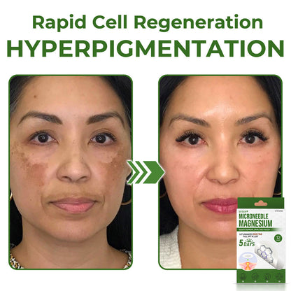 GFOUK® Magnesium MicroNeedle Quick Remove Skin Tag Patches