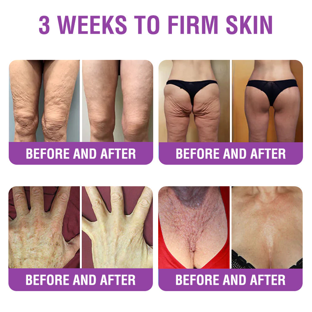 FDA Official: Furzero® Queen Nectar Peptide + Bakuchiol Skin Restoration Cream - Anti-aging, Hydrating, Skin Firming & Lifting, Skin Repair, Even Tone, Acne and Dark Spot Treatment, Wart and Mole Removal, and Psoriasis Relief.