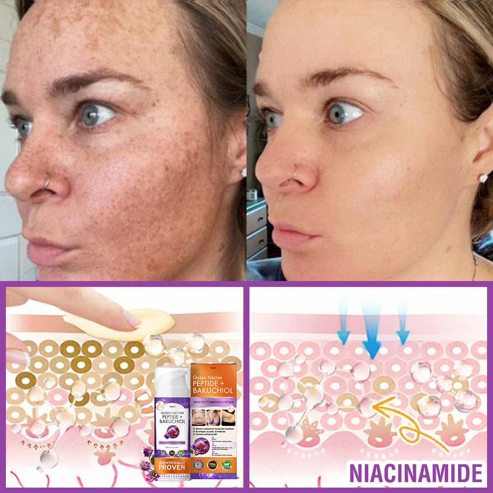 FDA Official: Furzero® Queen Nectar Peptide + Bakuchiol Skin Restoration Cream - Anti-aging, Hydrating, Skin Firming & Lifting, Skin Repair, Even Tone, Acne and Dark Spot Treatment, Wart and Mole Removal, and Psoriasis Relief.