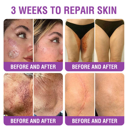 FDA Official: Furzero® Queen Nectar Peptide + Bakuchiol Skin Restoration Cream - Anti-aging, Hydrating, Skin Firming & Lifting, Skin Repair, Even Tone, Acne and Dark Spot Treatment, Wart and Mole Removal, and Psoriasis Relief.