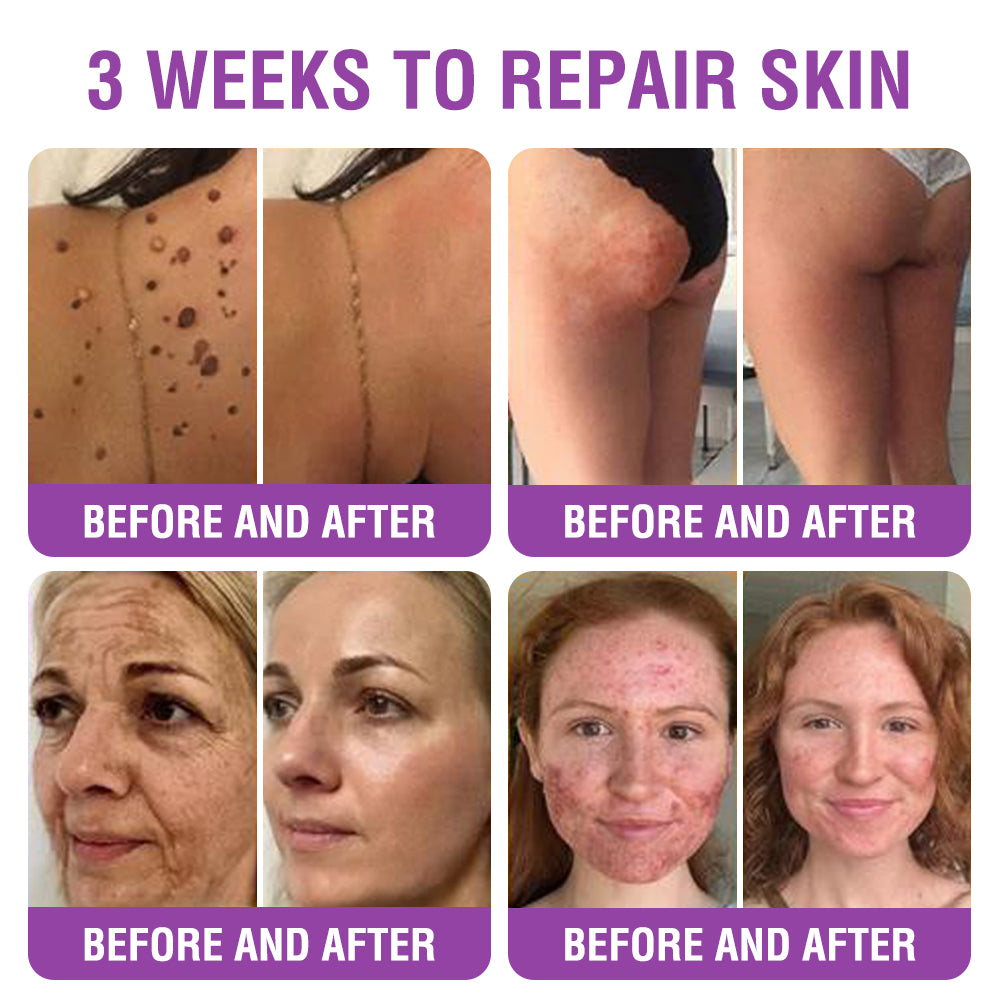 FDA Official: Furzero® Queen Nectar Peptide + Bakuchiol Skin Restoration Cream - Anti-aging, Hydrating, Skin Firming & Lifting, Skin Repair, Even Tone, Acne and Dark Spot Treatment, Wart and Mole Removal, and Psoriasis Relief.