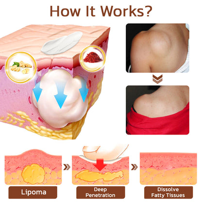 GFOUK™ Lumpless Lipoma Treatment Cream